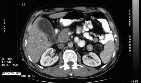 Imagen diagnóstica de Tomografía (CT)